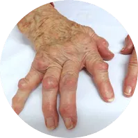 main avec douleur articulaire